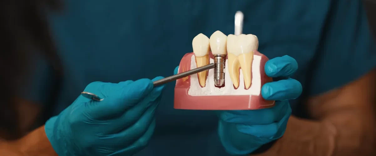 Çayırova İmplant Tedavisi