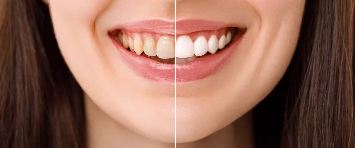 Çayırova Diş Beyazlatma